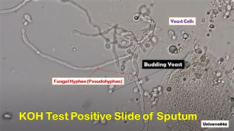 koh test positive result